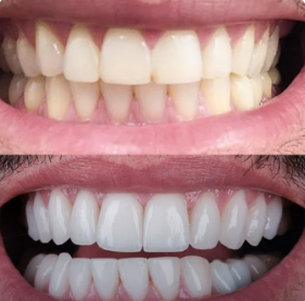Before and after case 2