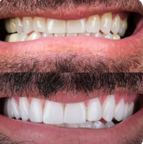 Before and after case 4